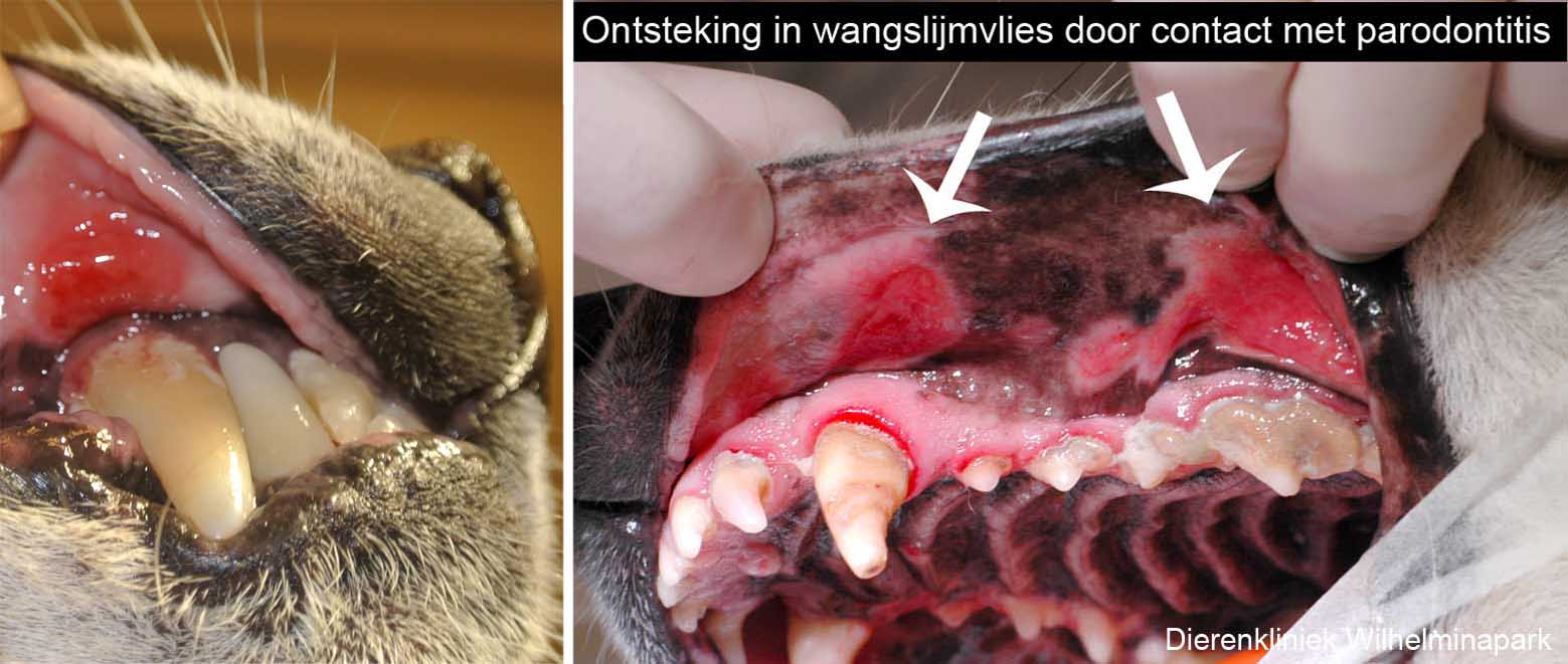 Contact onsteking in het mondslijmvlies door ernstig tandsteen met parodontitis